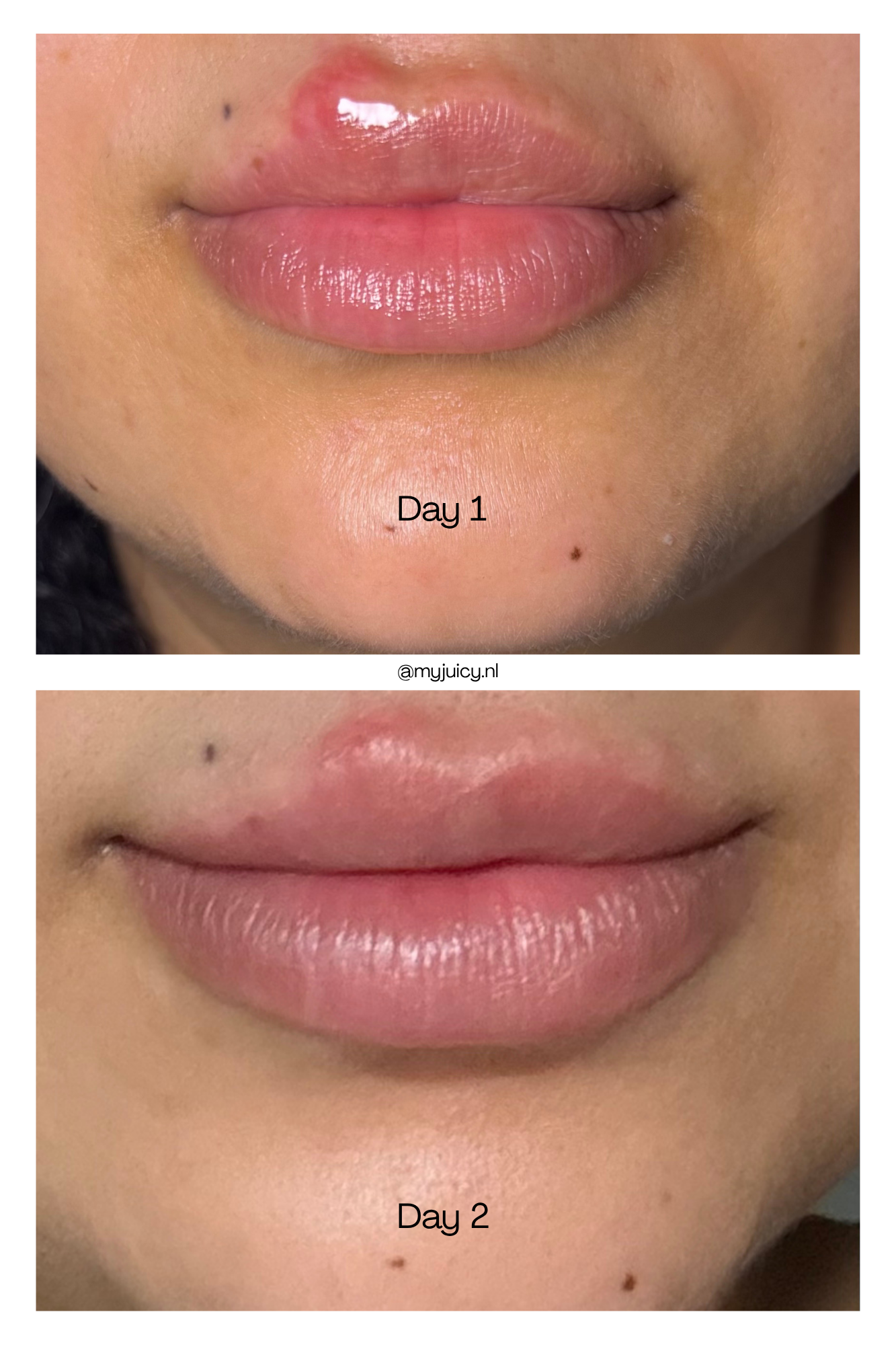 !PRE-ORDER! DEEP LIP TREATMENT - CLEAR